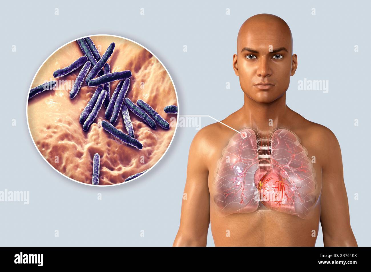 Secondary tuberculosis infection and closeup view of Mycobacterium