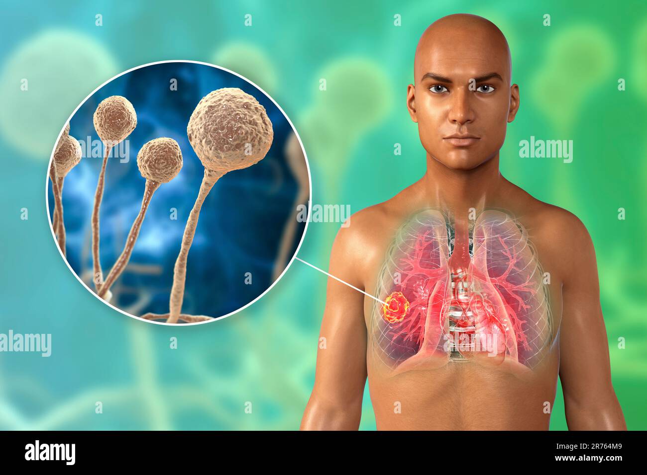 Pulmonary mucormycosis (or zygomycosis), a lung disease caused by Mucor