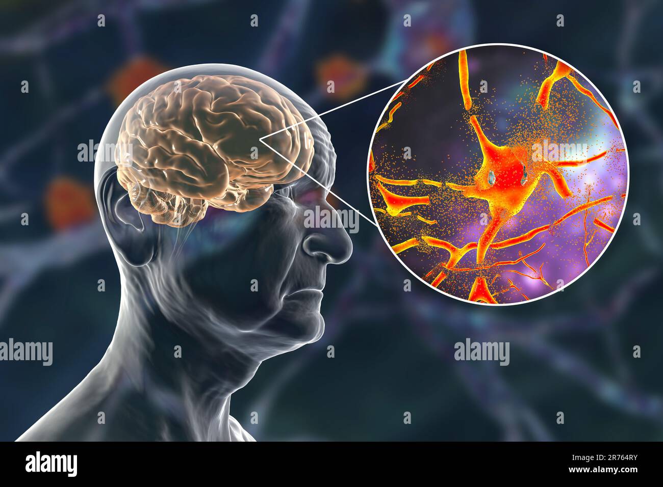 Dementia and Alzheimer's disease, conceptual computer illustration showing neurodegeneration and progressive impairment of brain functions in the elde Stock Photo