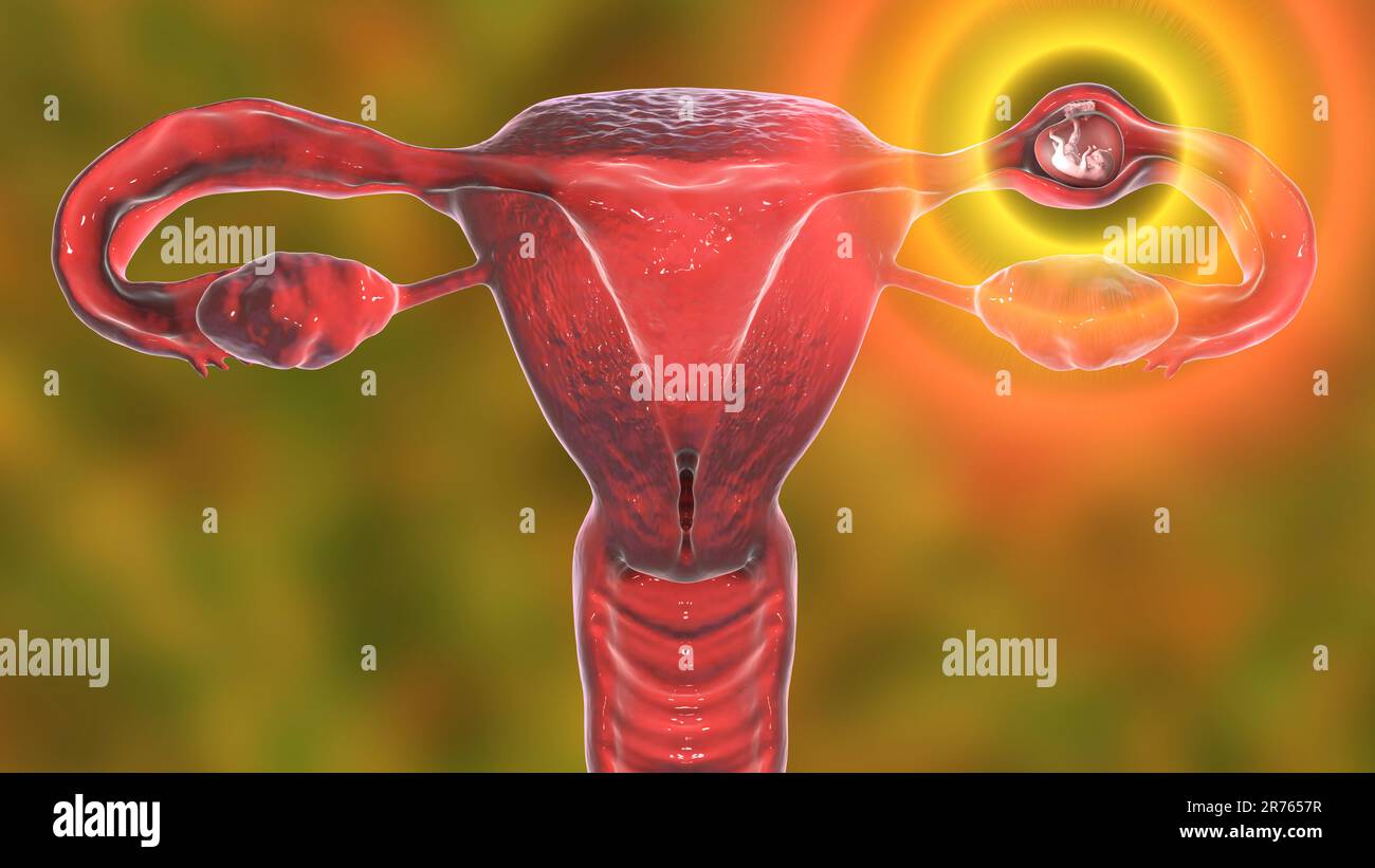 Ectopic pregnancy, illustration. The embryo has implanted in the