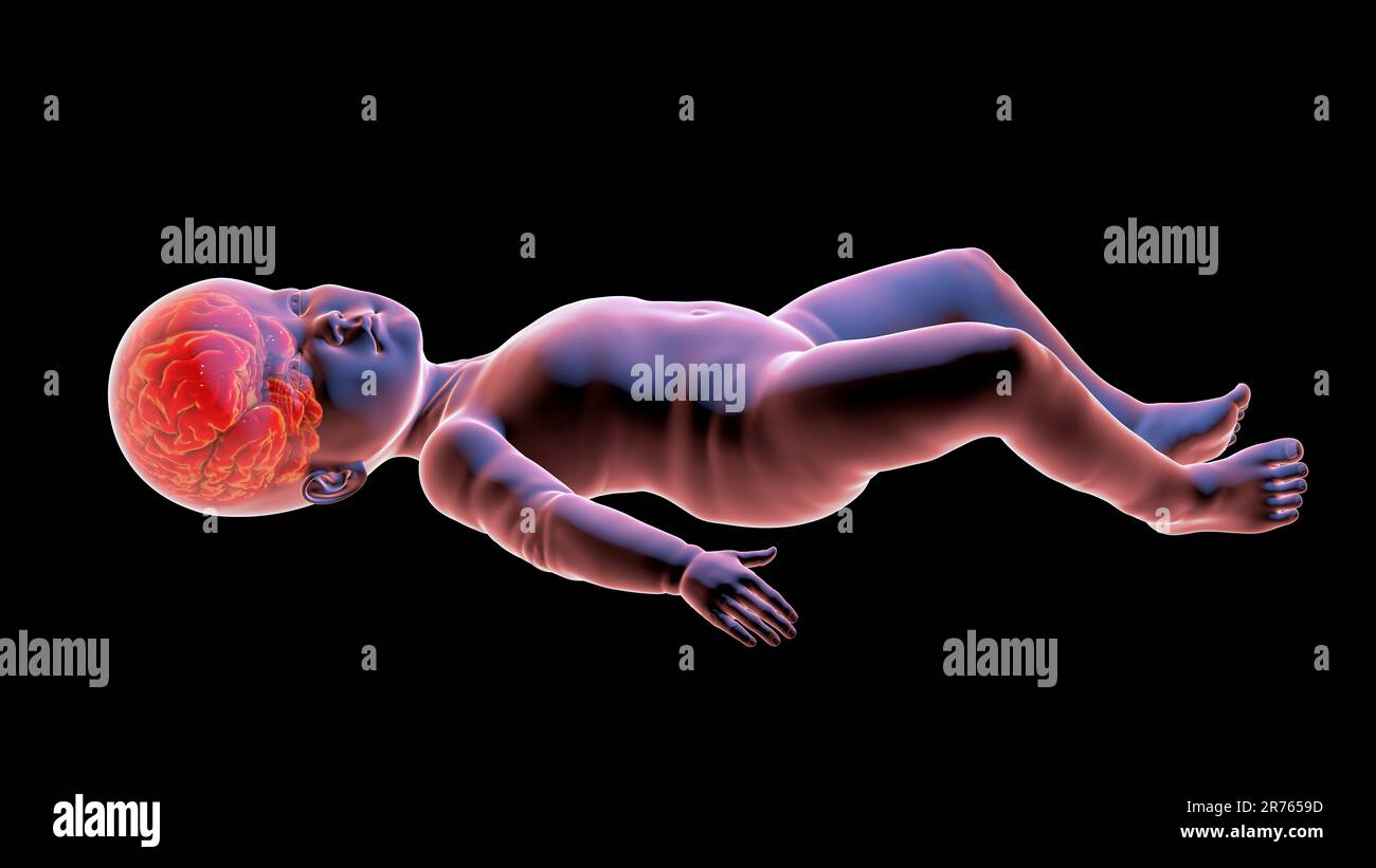 A child with macrocephaly, enlarged brain, hypotony, mental and motor delay due to genetic disorder, computer illustration. Stock Photo