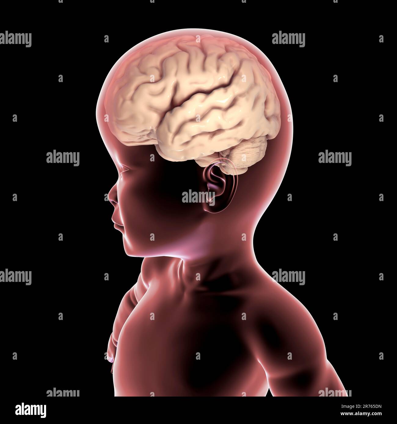 A child with macrocephaly, enlarged brain, hypotony, mental and motor delay due to genetic disorder, computer illustration. Stock Photo