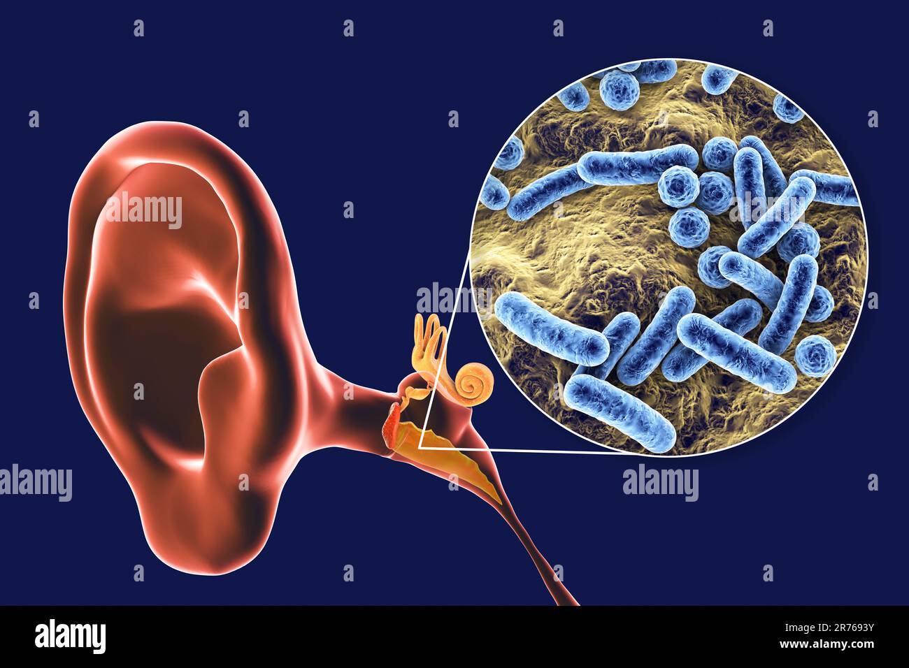 Otitis media ear infection and closeup view of bacteria, the
