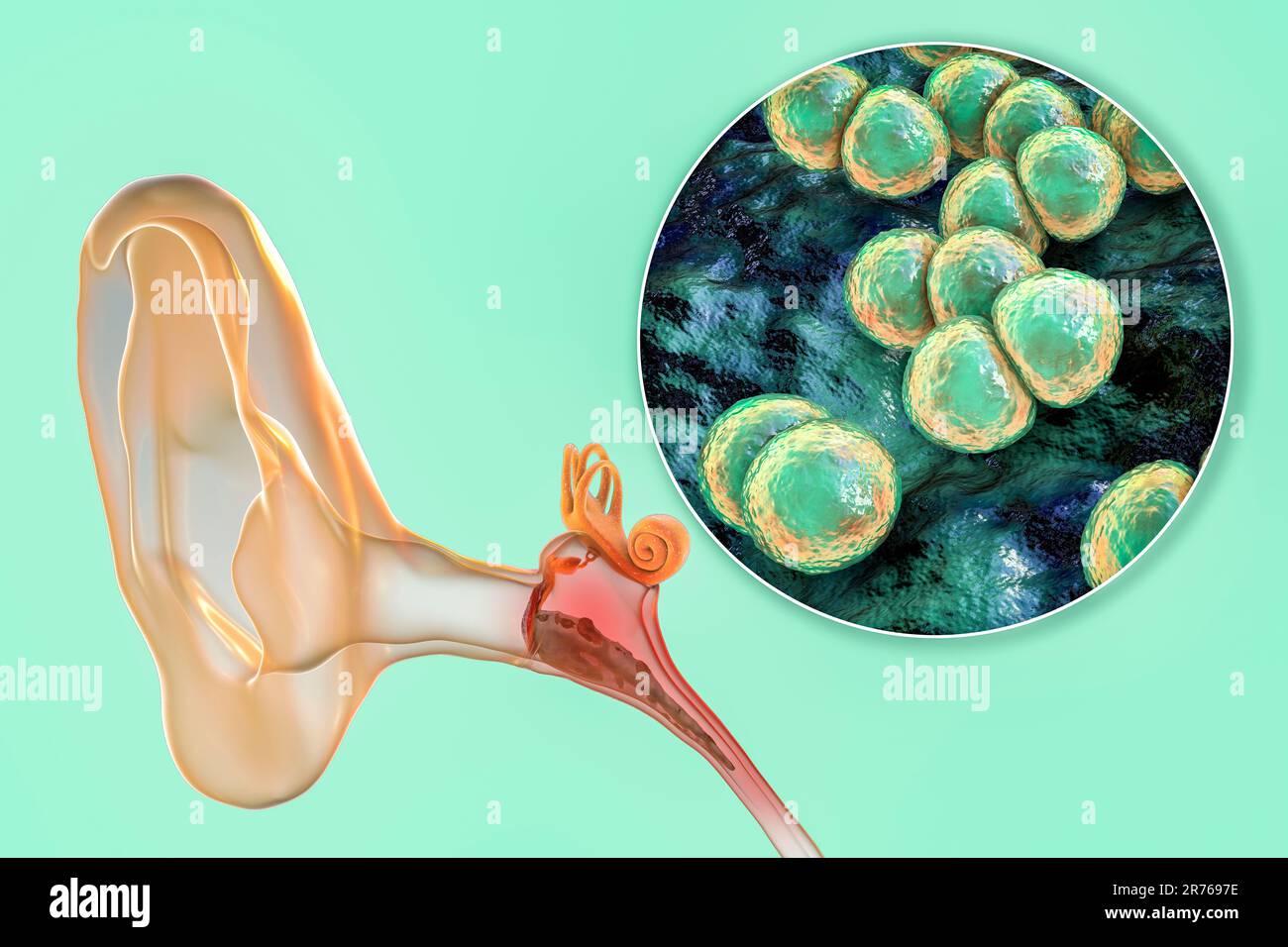 Otitis media ear infection caused by bacteria Streptococcus pneumoniae