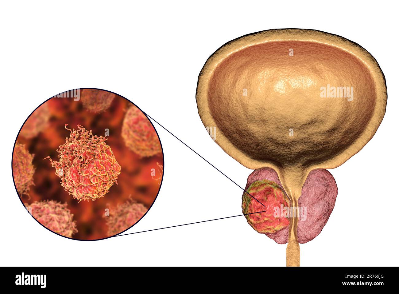 Prostate cancer. Computer artwork of a cancerous tumour in the prostate gland (right) and close-up view of prostate cancer cells (left). The urethra c Stock Photo
