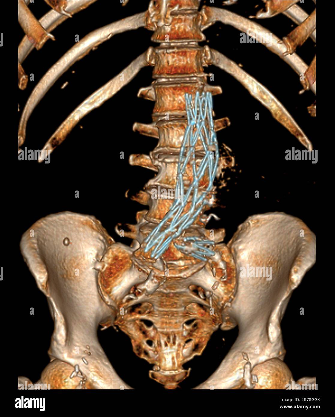Coloured 3D computed tomography (CT) angiogram scan of the abdomen of a ...