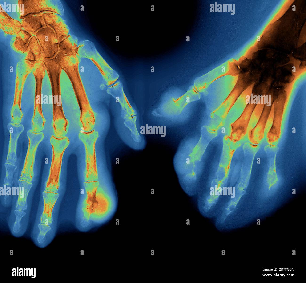 Coloured Xray of the hands of a 65 year old patient with gout in the