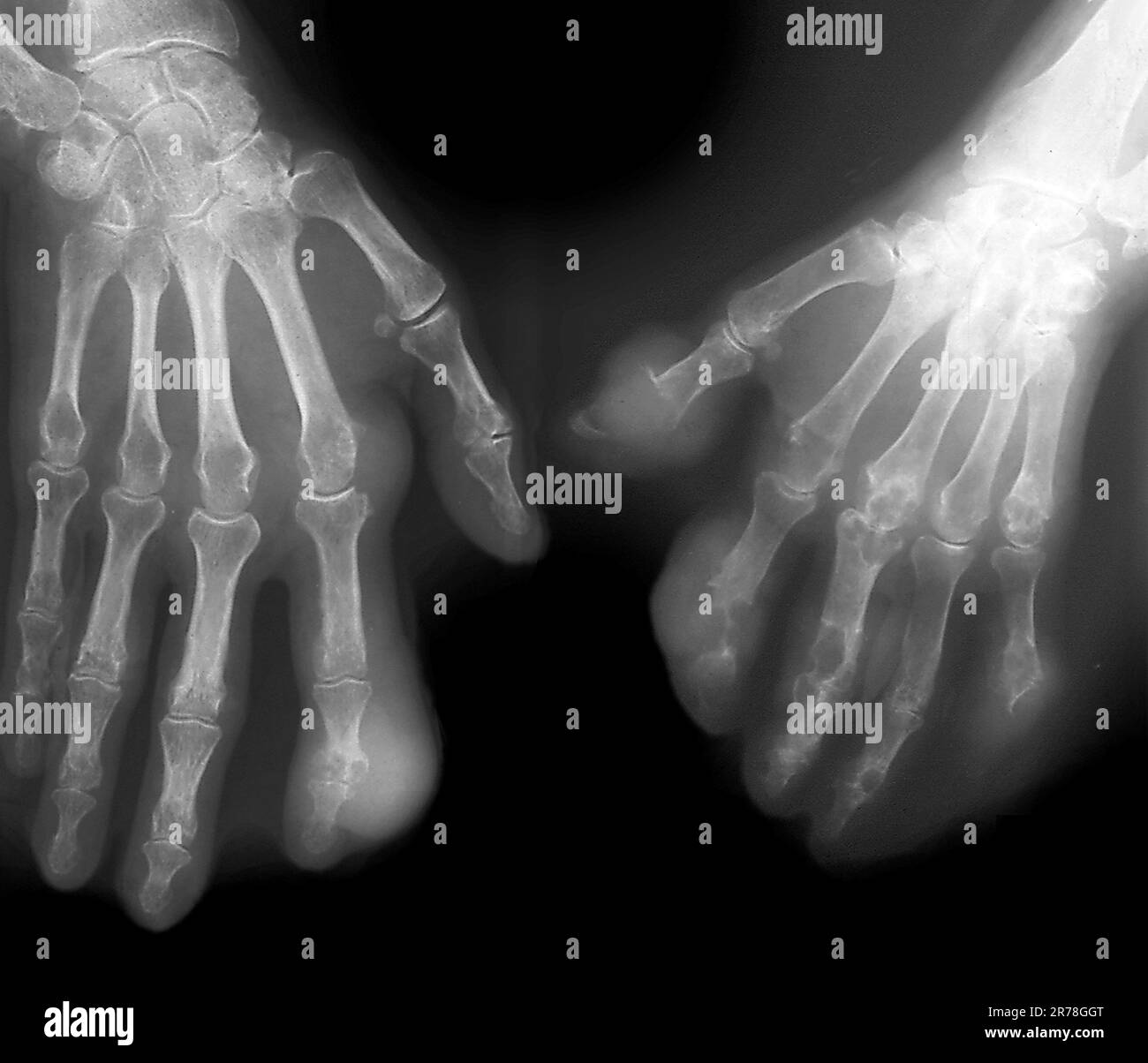 x-ray-of-the-hands-of-a-65-year-old-patient-with-gout-in-the-joints-of