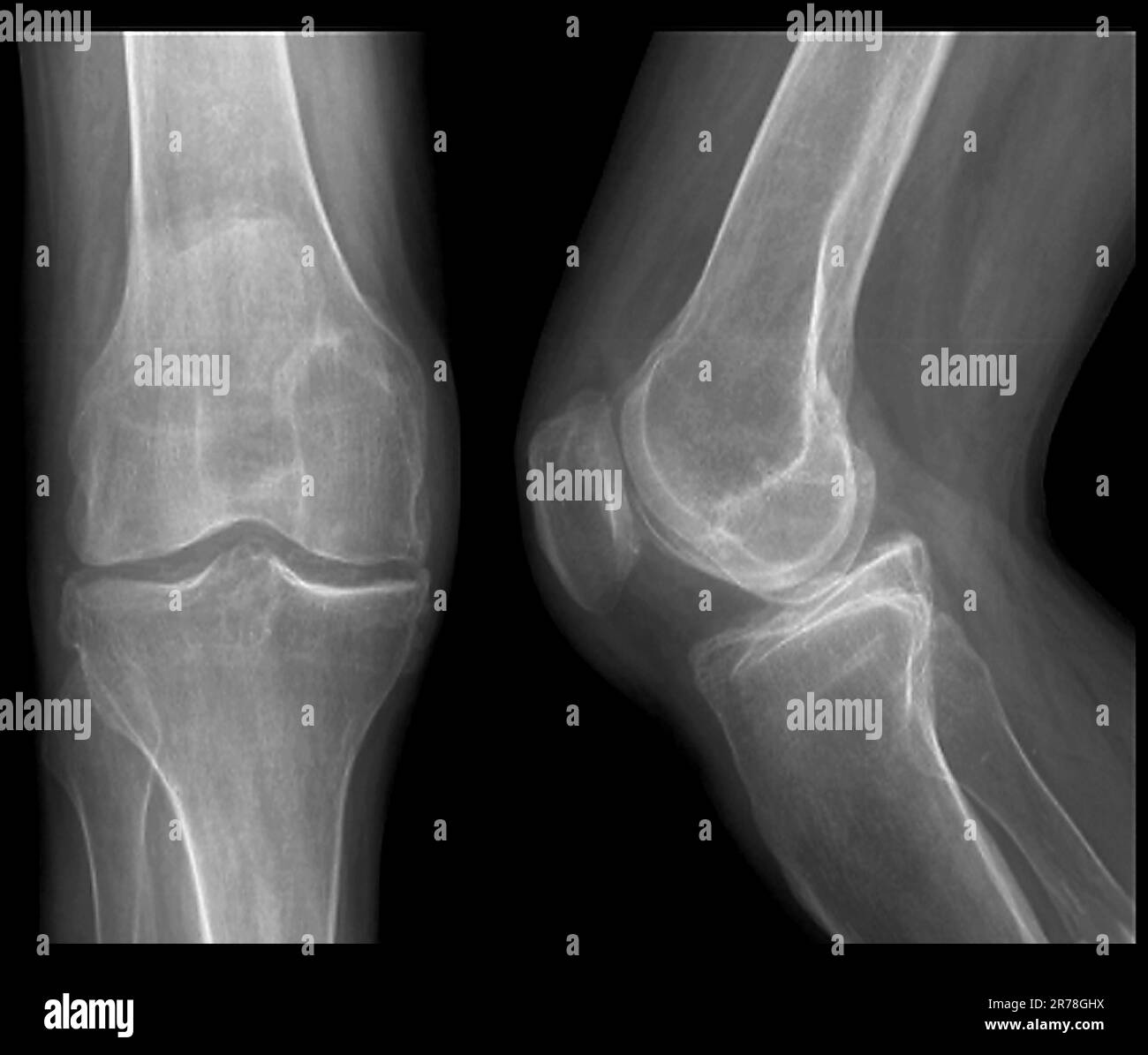 Xrays of the knee joint of a 59 year old male patient affected by chondrocalcinosis, or