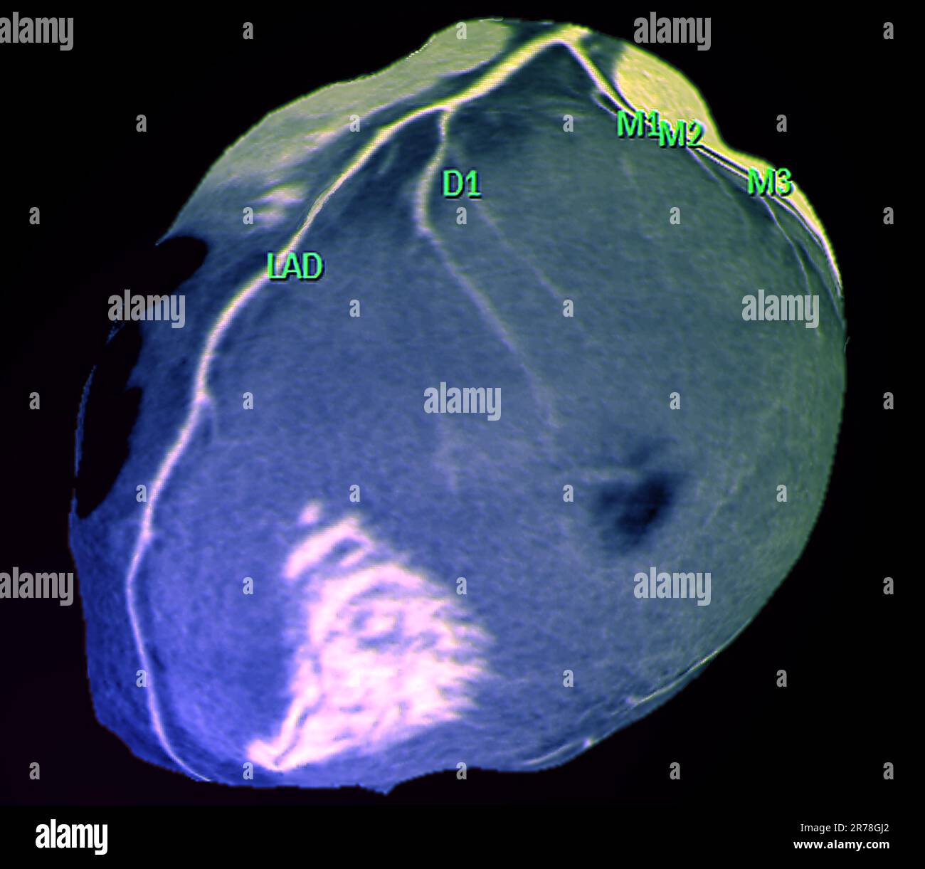 Coloured 3D computed tomography (CT) angiogram scan of the heart of a
