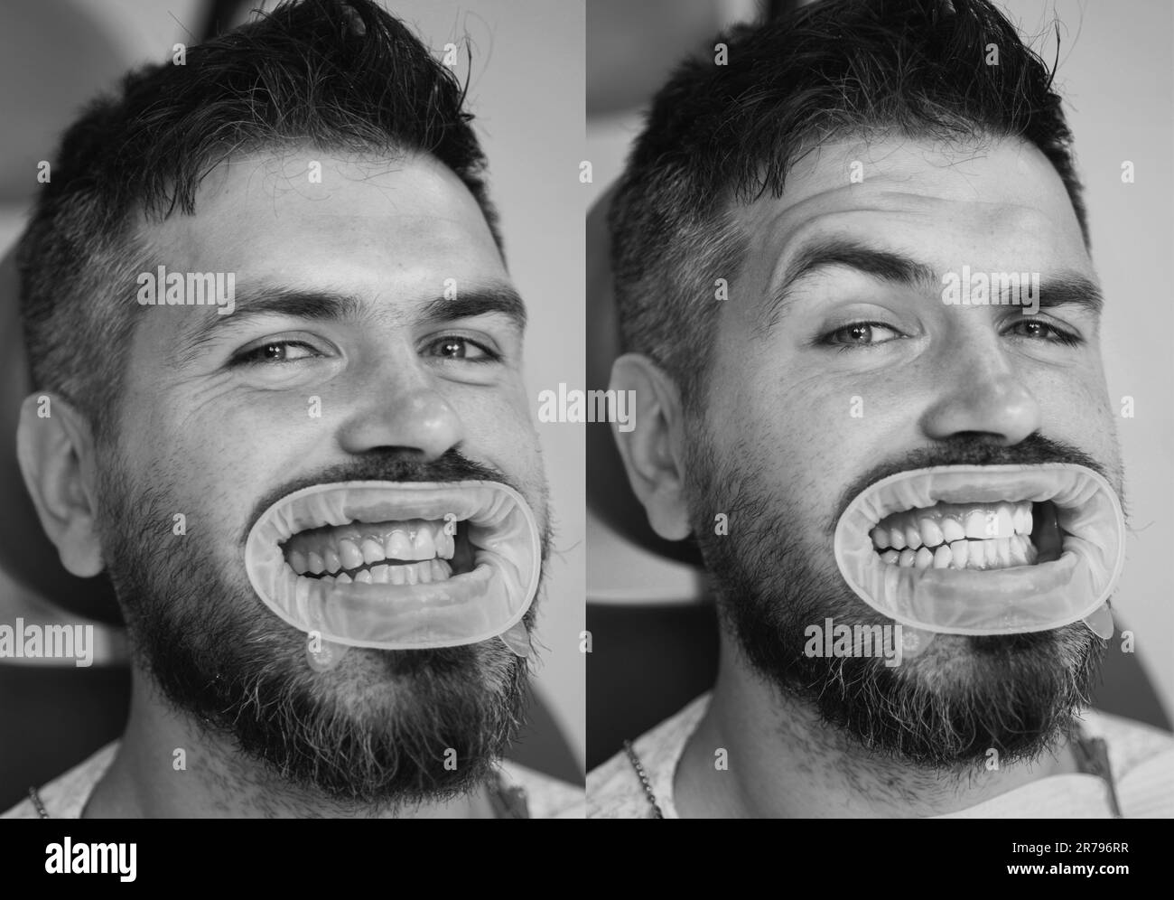White teeth before and after concept. Closeup detail of man teeth before and after whitening