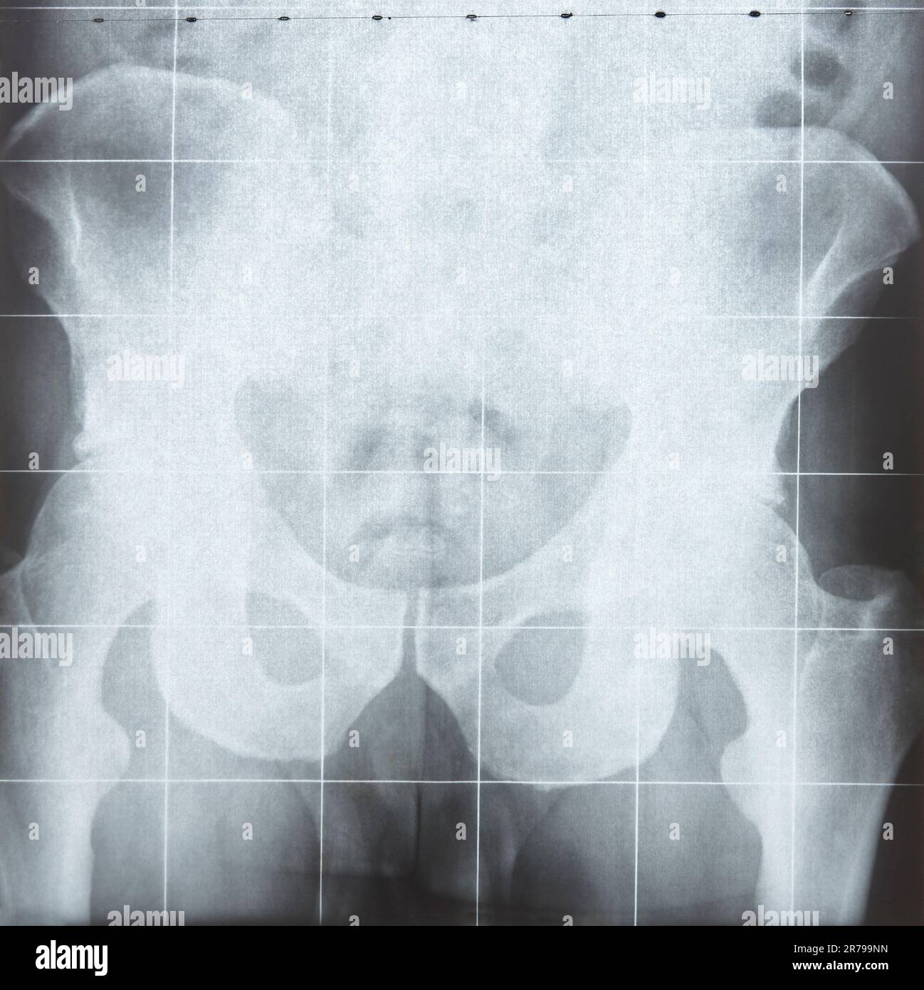 XRays resonance imaging. Hip detail. Medical procedure diagnosis