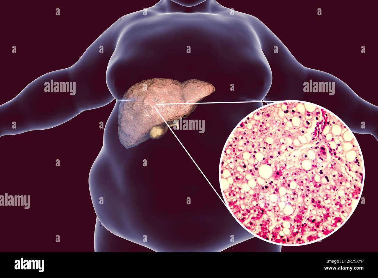 Obese man with fatty liver, 3D illustration and photomicrograph of liver steatosis. Conceptual image for non-alcoholic fatty liver disease Stock Photo