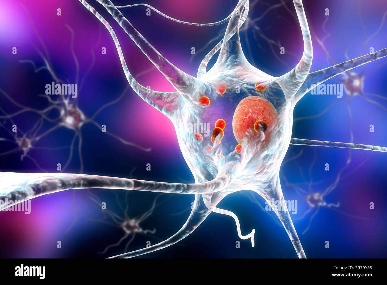 Parkinson's disease. 3D illustration showing neurons containing Lewy