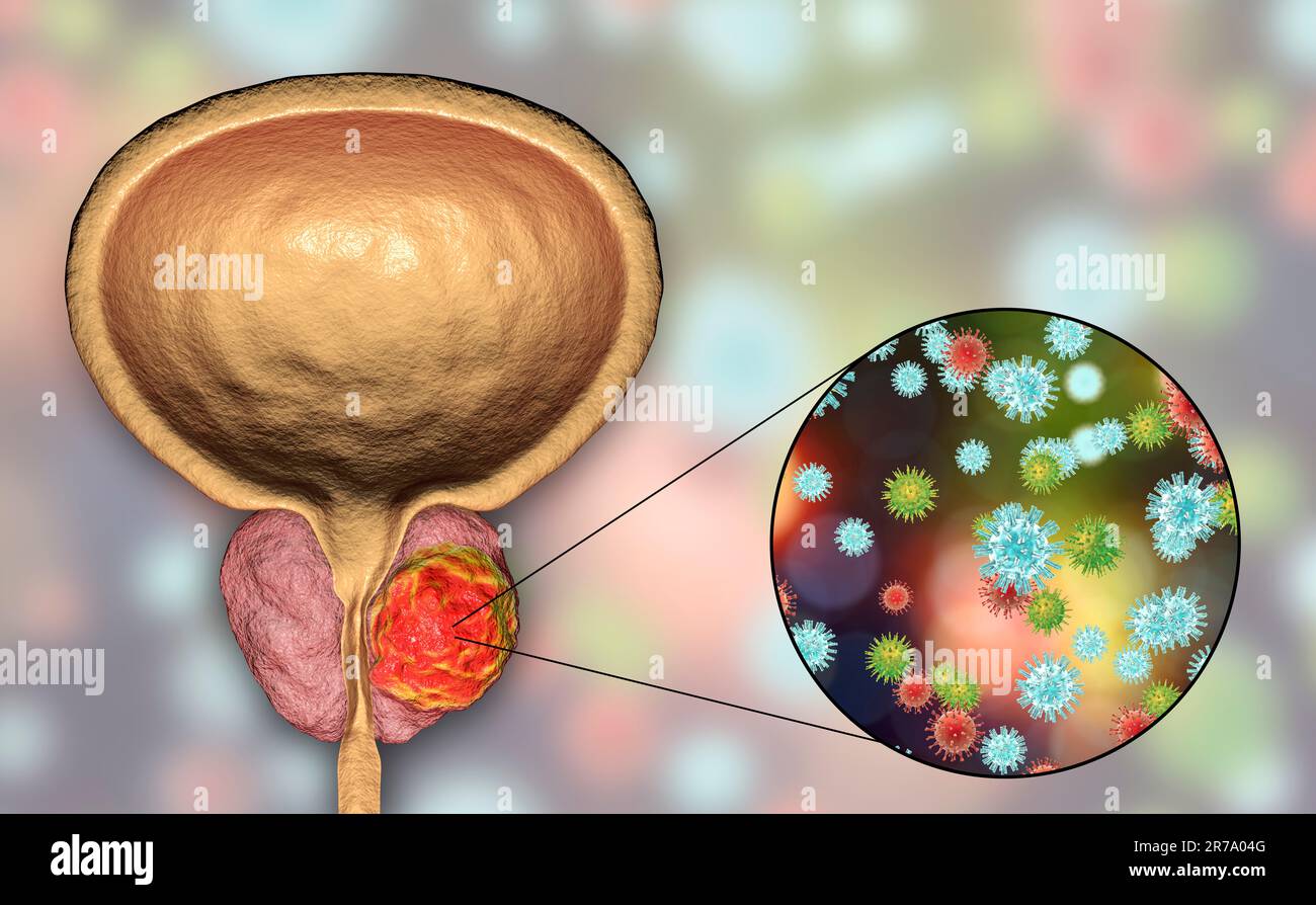 Conceptual image for viral ethiology of prostate cancer. 3D illustration showing viruses infecting prostate gland which develops cancerous tumor Stock Photo