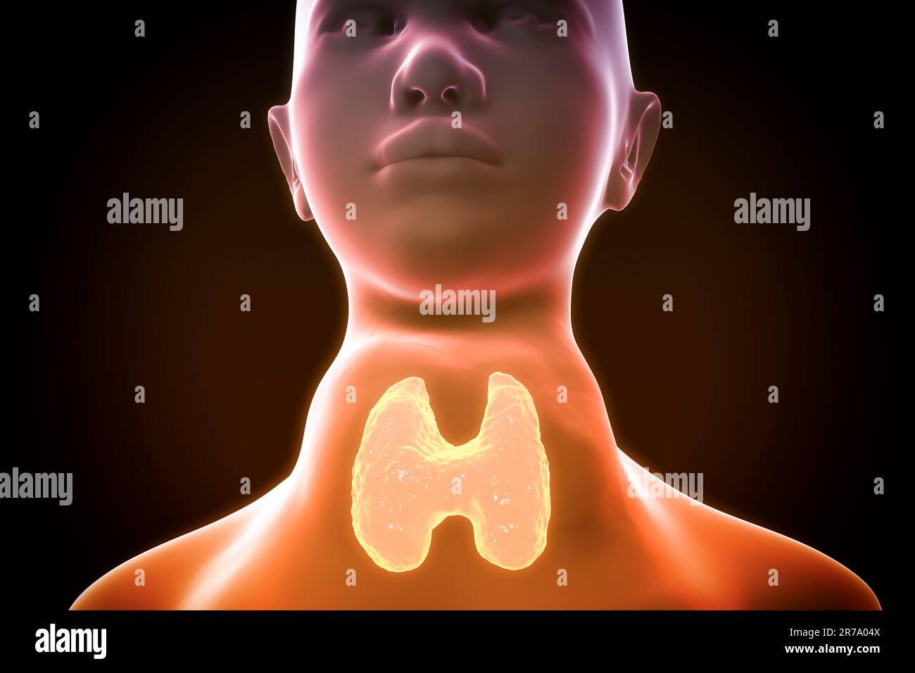 Toxic Diffuse Goiter Flajani Basedow Graves Disease 3d Illustration Showing Enlarged Thryoid 4923