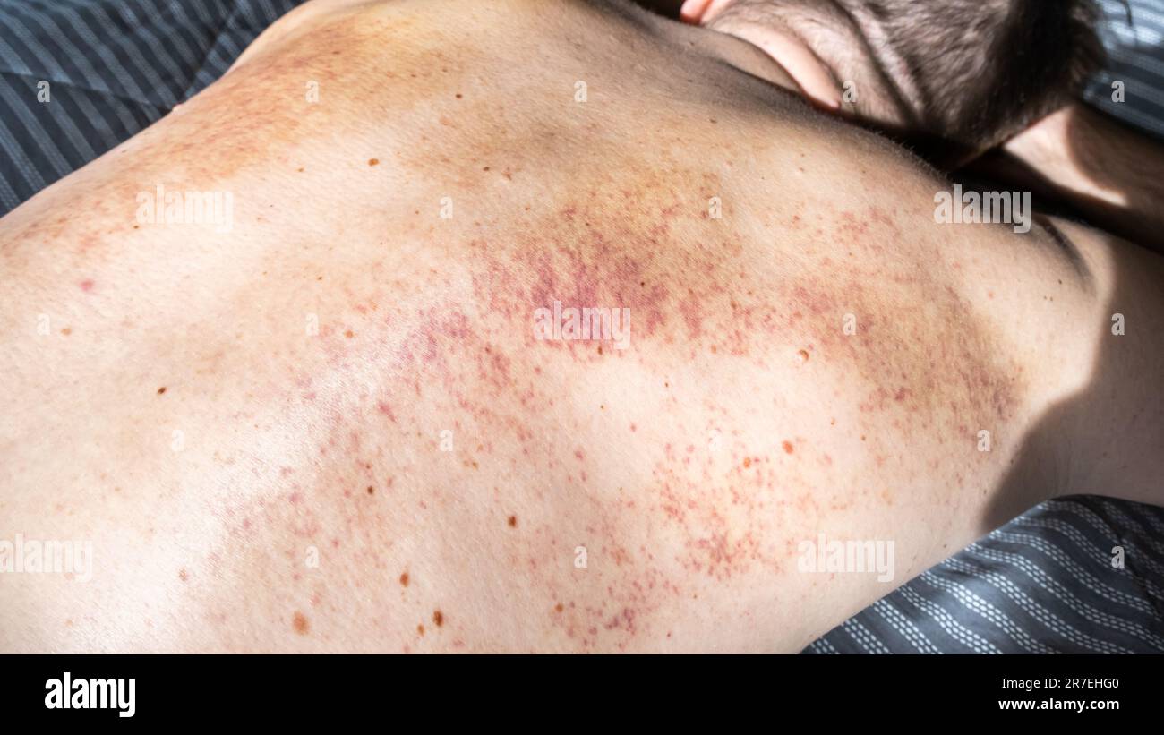 Close up bruises on the back of a man after a massage Stock Photo Alamy