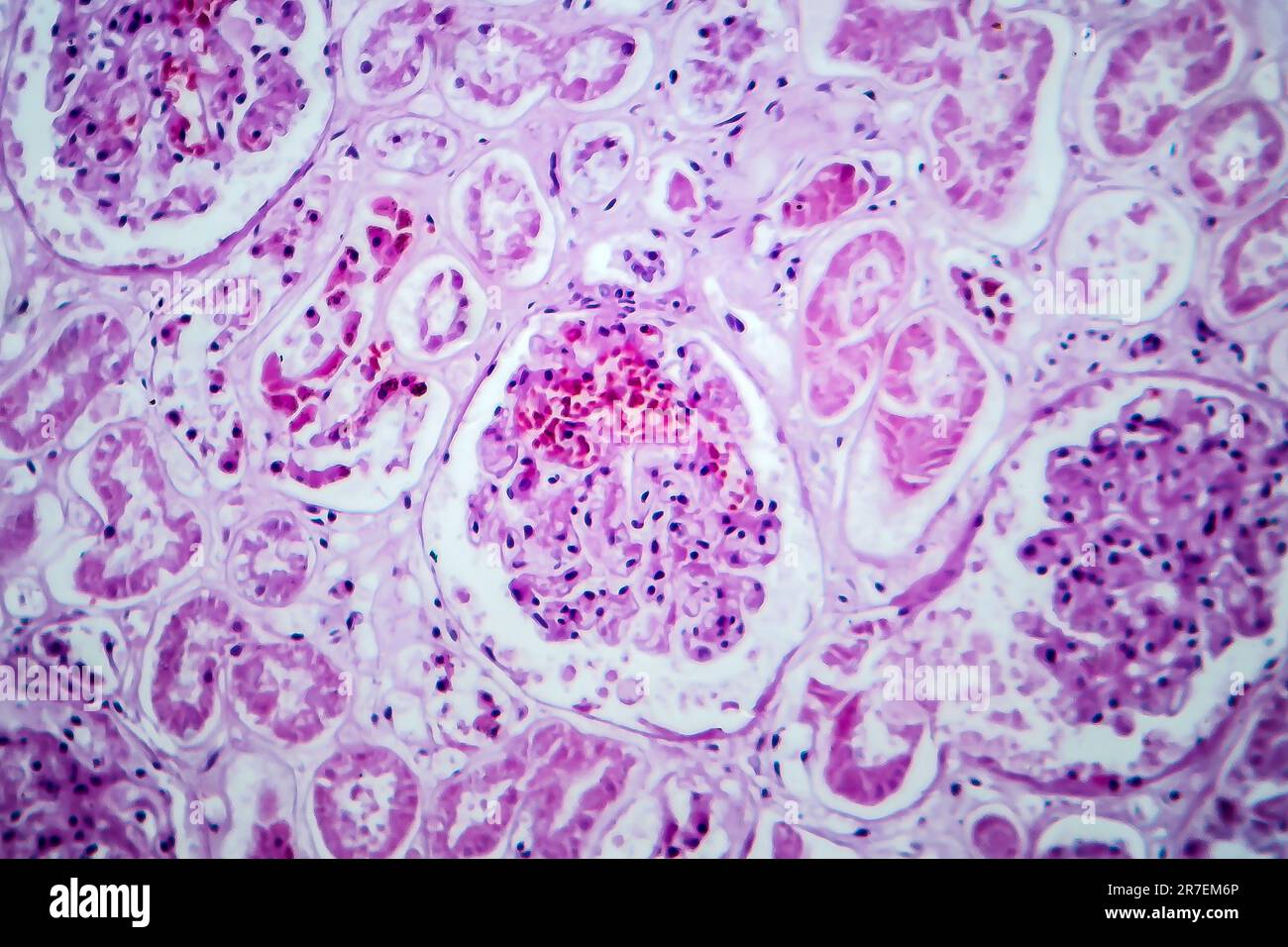 Acute glomerulonephritis hi-res stock photography and images - Alamy