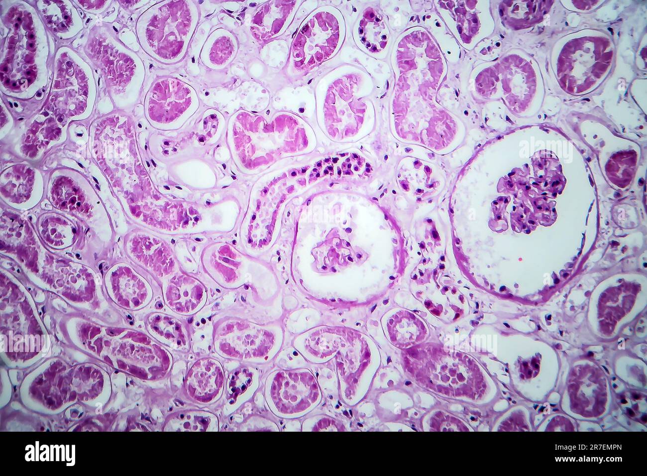 Glomerulonephritis. Light micrograph of tissue from a kidney in a case