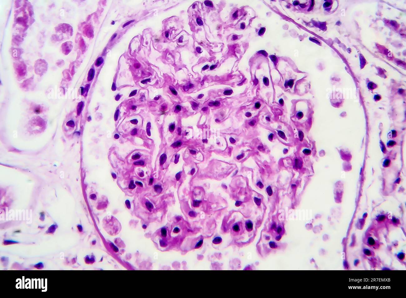 Acute glomerulonephritis hi-res stock photography and images - Alamy