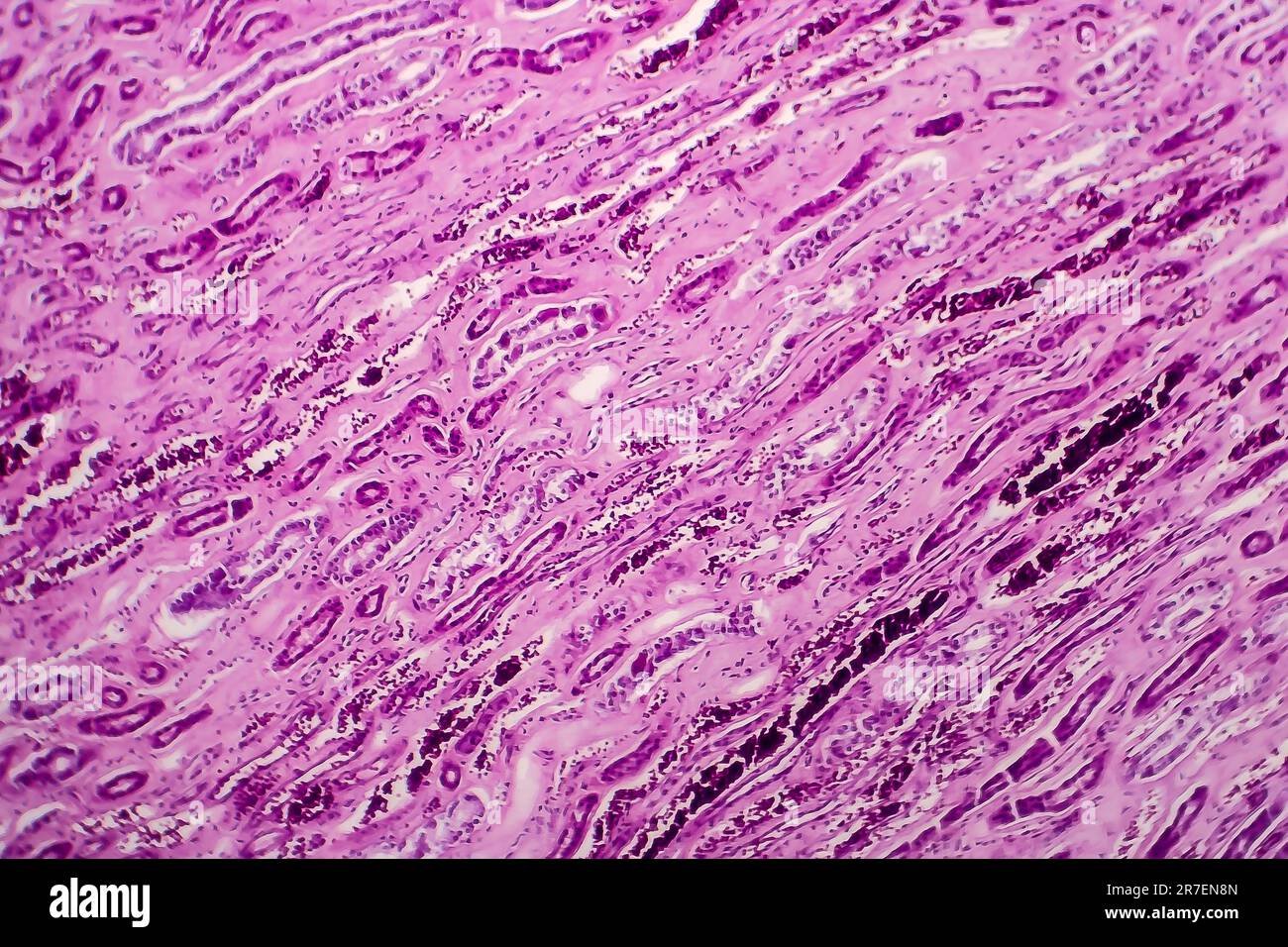 Glomerulonephritis. Light micrograph of tissue from a kidney in a case ...