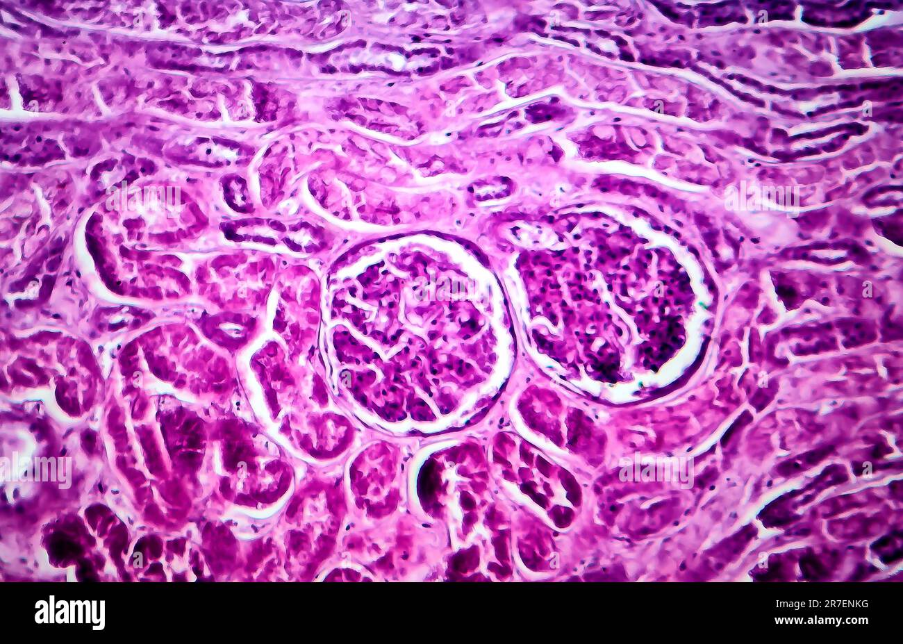 Glomerulonephritis. Light micrograph of tissue from a kidney in a case of diffuse proliferative glomerulonephritis, a form of chronic glomerulonephrit Stock Photo