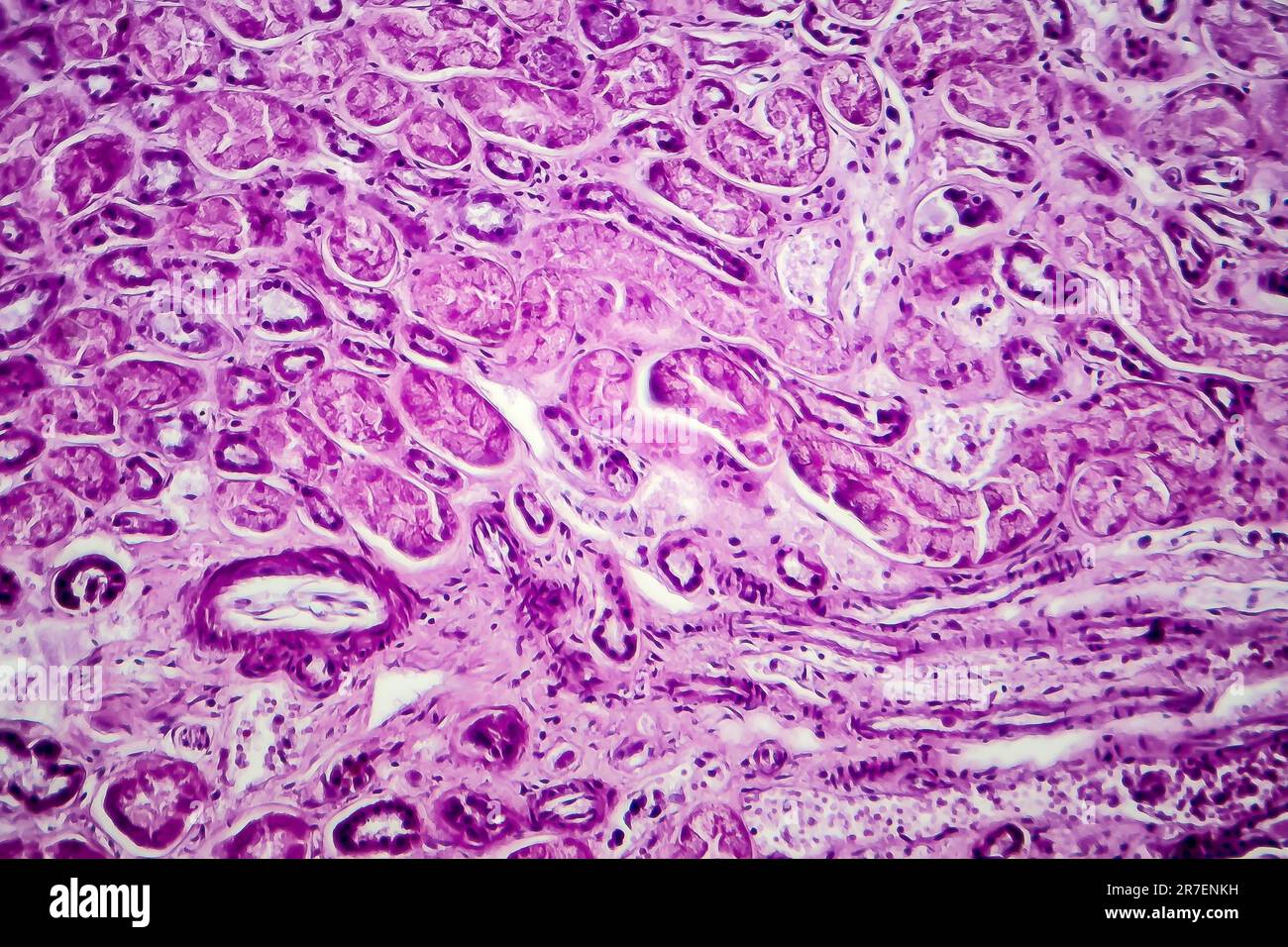 Glomerulonephritis. Light micrograph of tissue from a kidney in a case of diffuse proliferative glomerulonephritis, a form of chronic glomerulonephrit Stock Photo