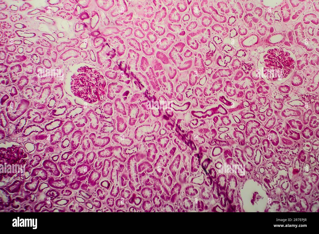 Glomerulonephritis. Light micrograph of tissue from a kidney in a case ...