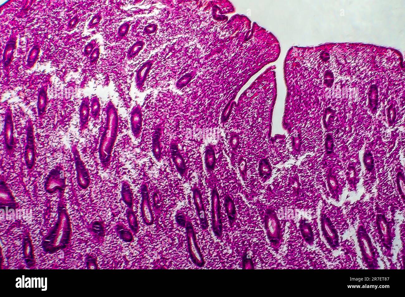 Endometrial hyperplasia. Light micrograph of a section through tissue from the endometrium, in a