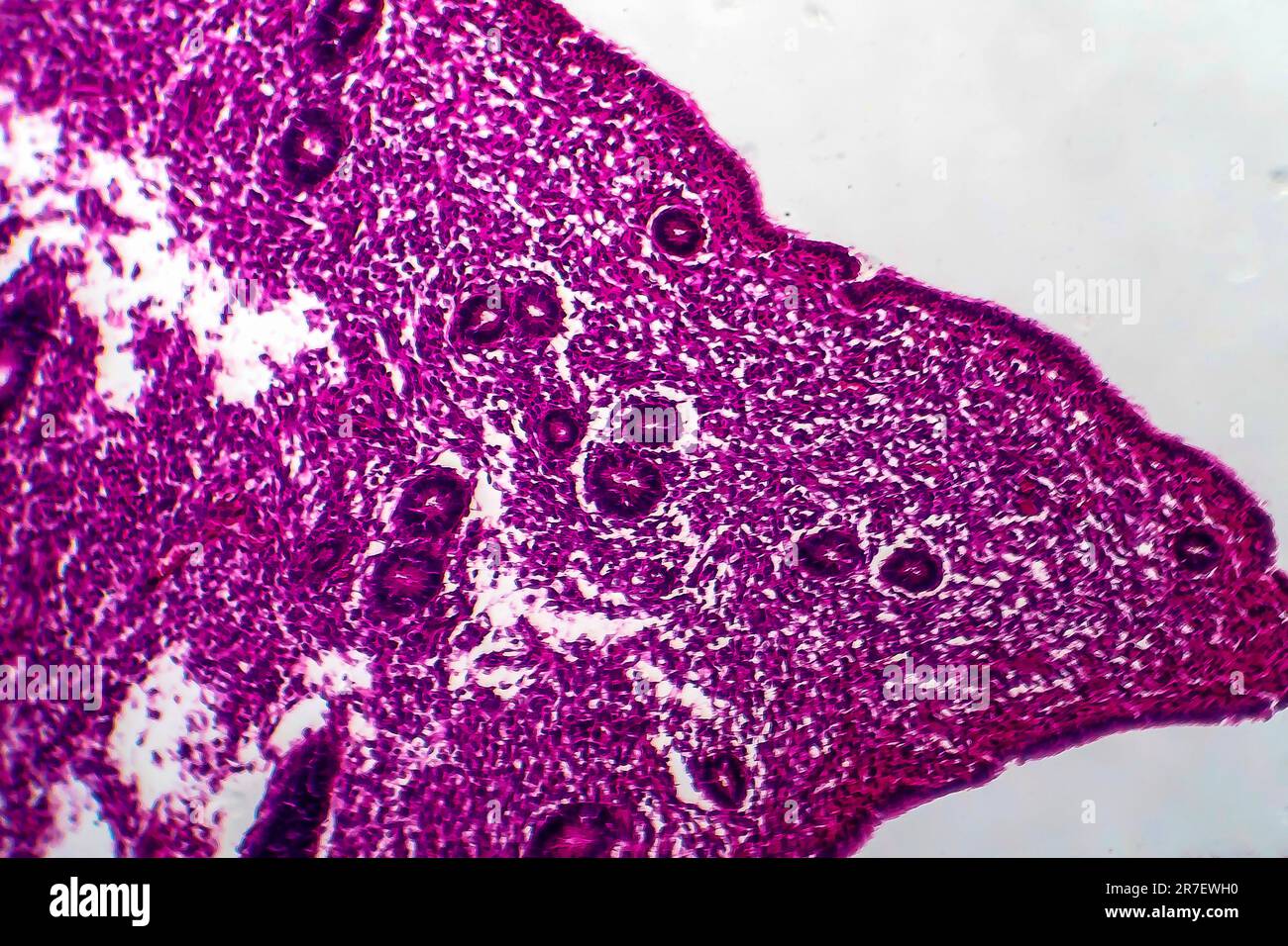 Endometrial hyperplasia. Light micrograph of a section through tissue