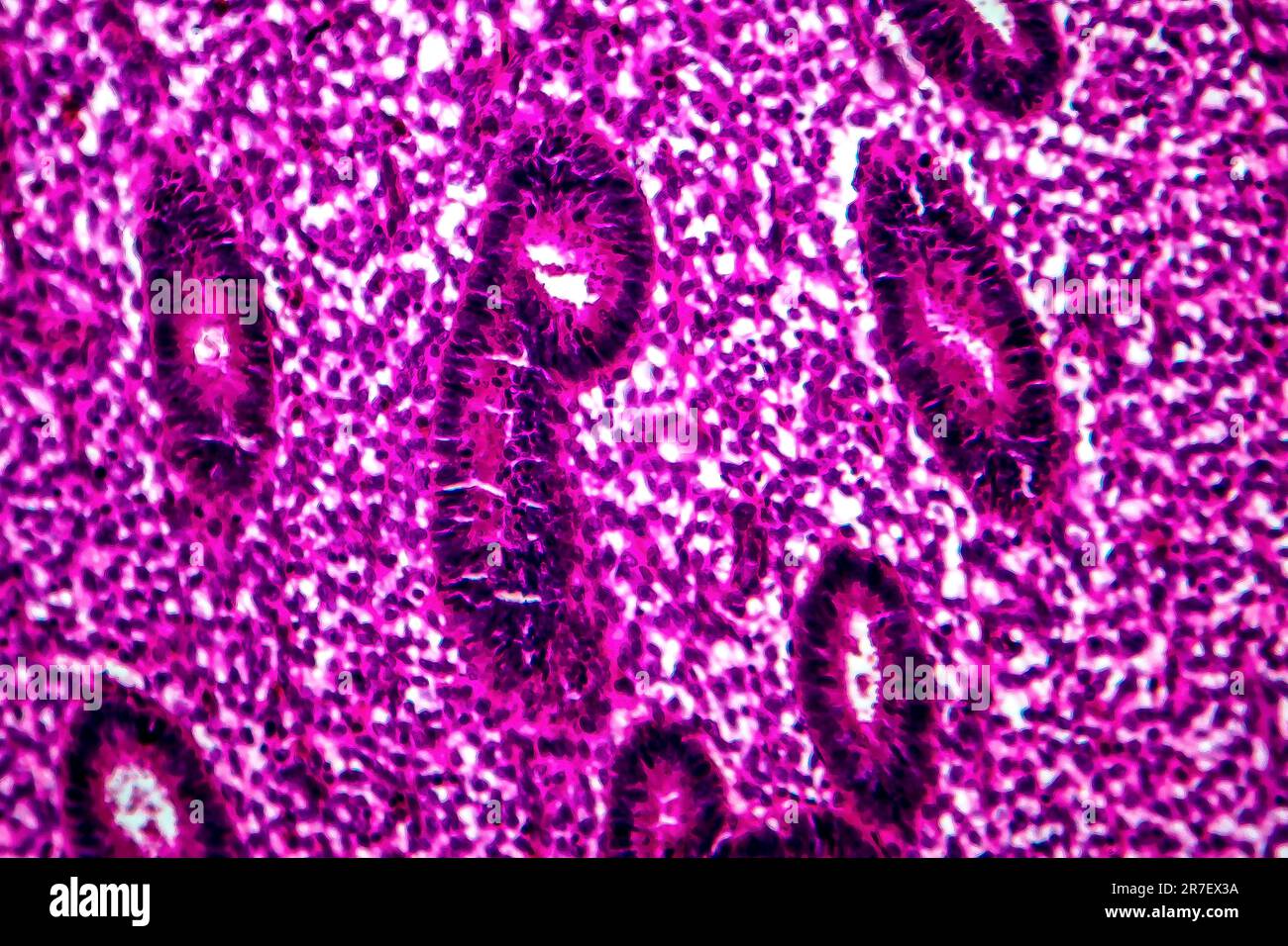 Endometrial hyperplasia. Light micrograph of a section through tissue
