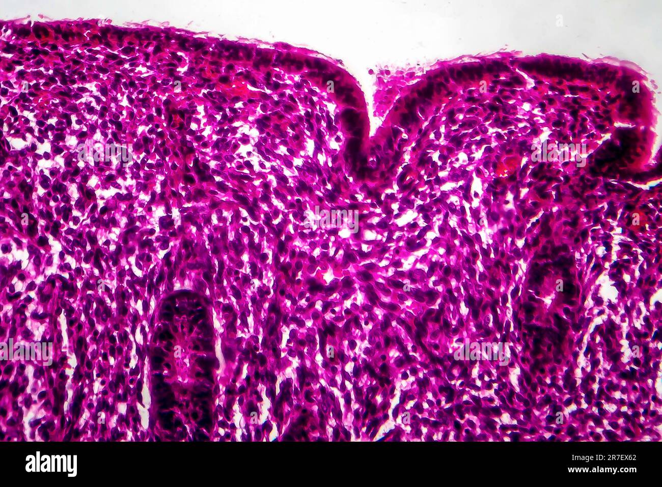 Endometrial hyperplasia. Light micrograph of a section through tissue