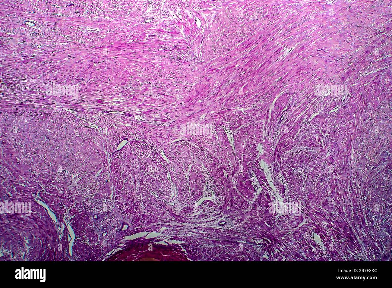 Uterine fibroid. Light micrograph (LM) of a section through tissue from the uterus, in a case of a uterine fibroids (leiomyoma). A fibroid is a benign Stock Photo