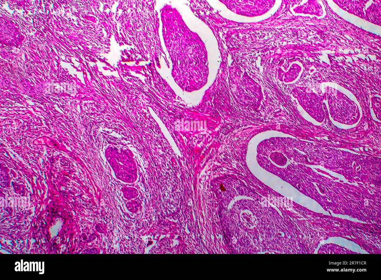 Cervical cancer. Light micrograph (LM) of a section through a squamous cell carcinoma of the cervix. Cervical cancer is a malignancy of the cervix, wh Stock Photo