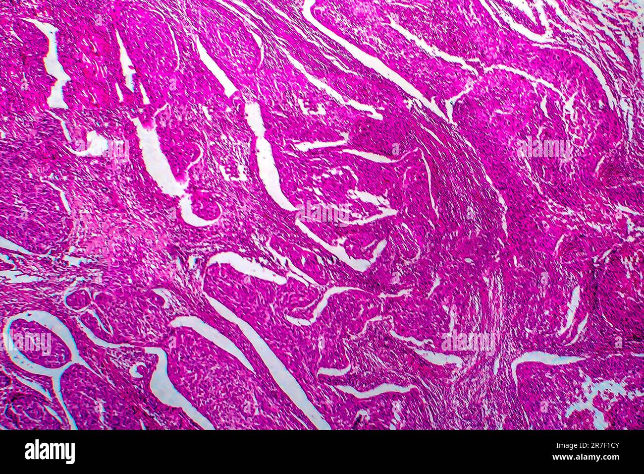 Cervical cancer. Light micrograph (LM) of a section through a squamous cell carcinoma of the cervix. Cervical cancer is a malignancy of the cervix, wh Stock Photo