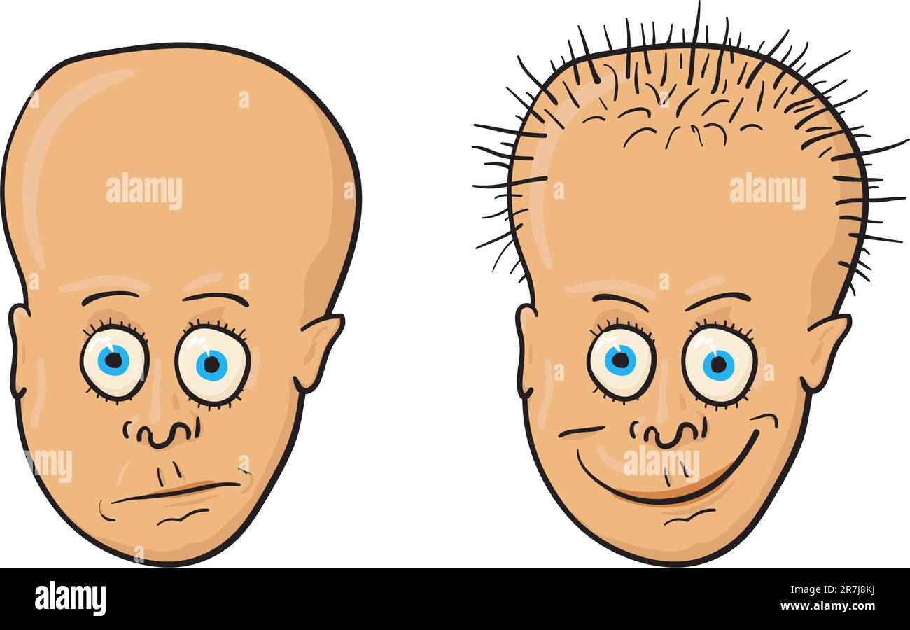 Comic vector illustration A patient with a bald head and growing hair
