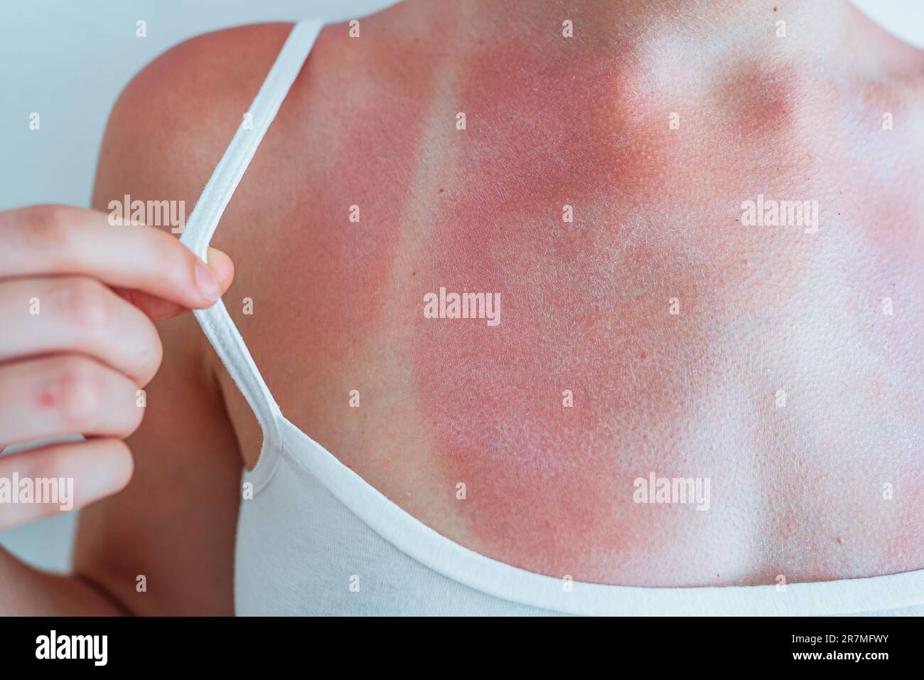 Sunburn marks hi-res stock photography and images - Alamy