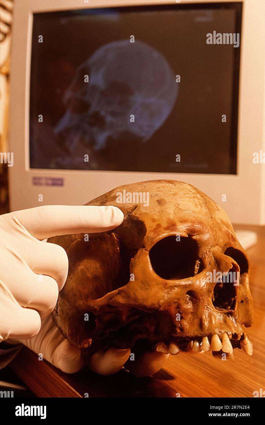 Italy Campania Pompeii villa Moregine, the archaeological excavations - Skull of Man death during the eruption of Vesuvio Volcano -  Study Stock Photo