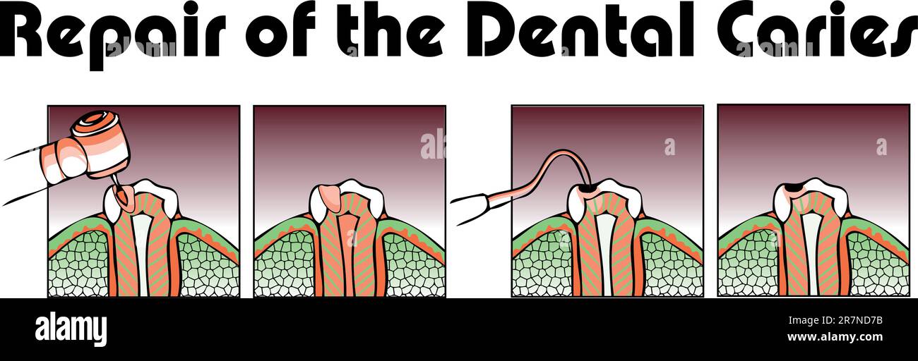 Repair of the Dental Caries Stock Vector Image & Art Alamy