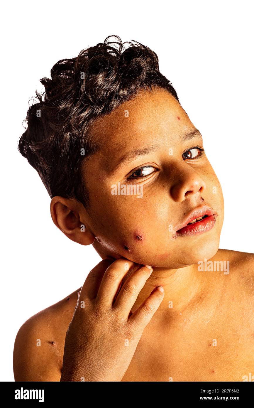 Chickenpox rash hi-res stock photography and images - Alamy