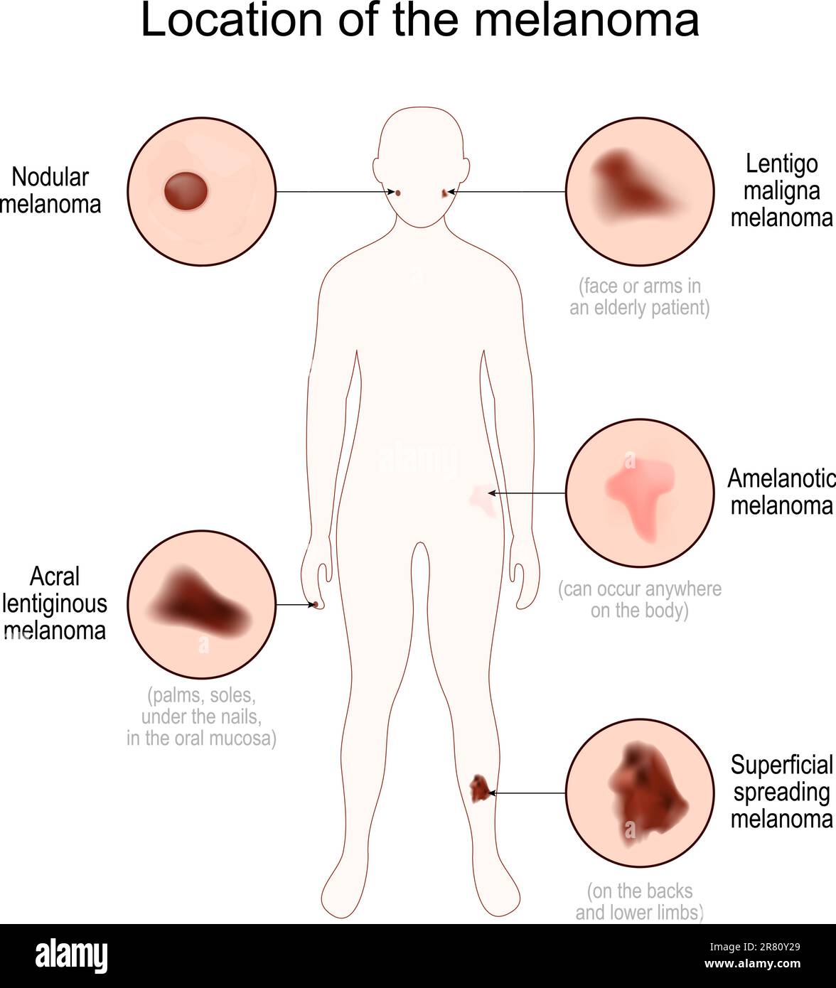 Location of the melanoma. Human body silhouette with Nodular, Acral lentiginous, Lentigo maligna, Superficial spreading and Amelanotic melanoma. Close Stock Vector