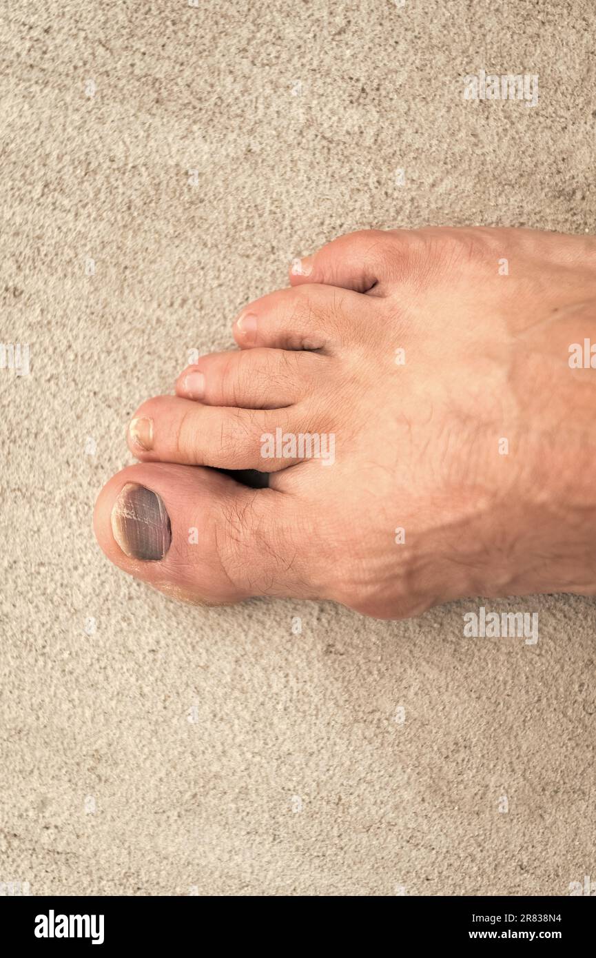 closeup of toe nail bruise hemtoma. toe nail bruise hemtoma on foot