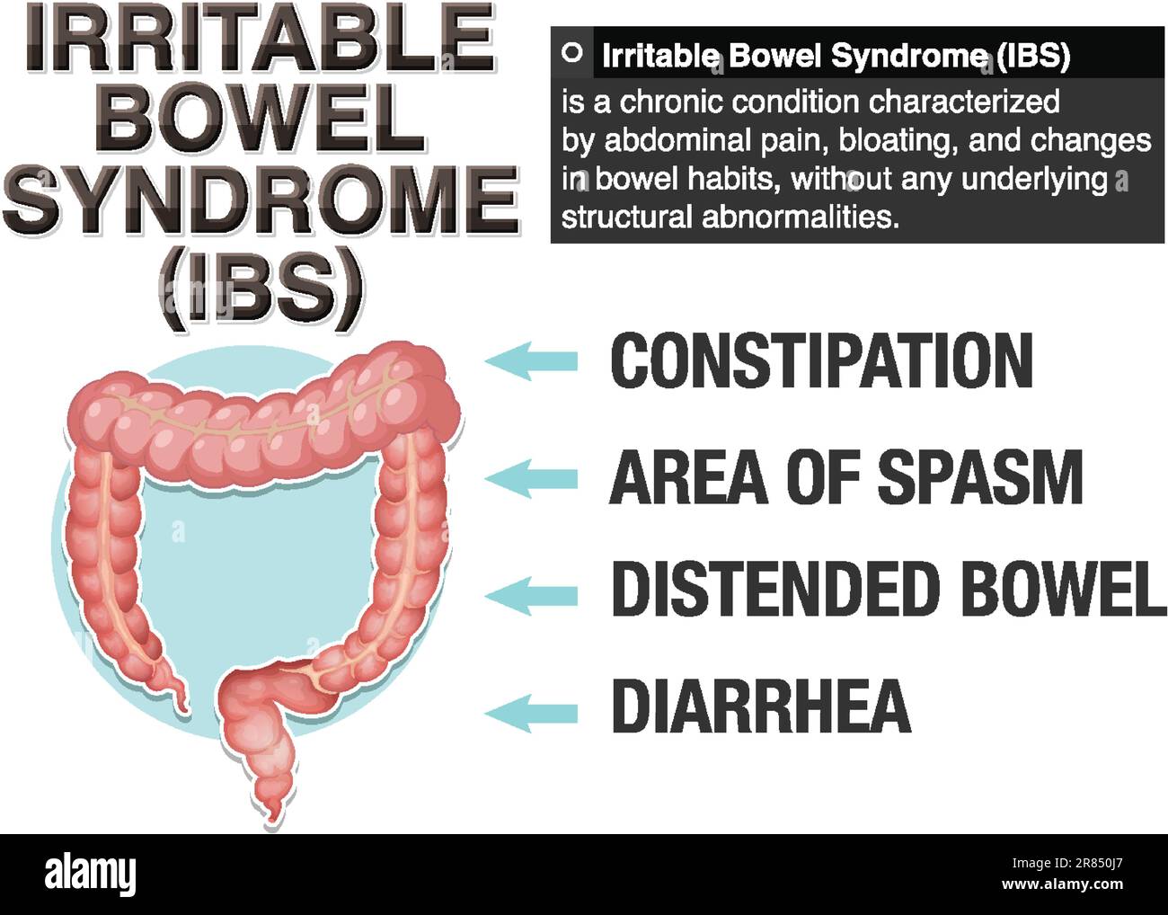 Irritable Bowel Syndrome (IBS) Infographic illustration Stock Vector