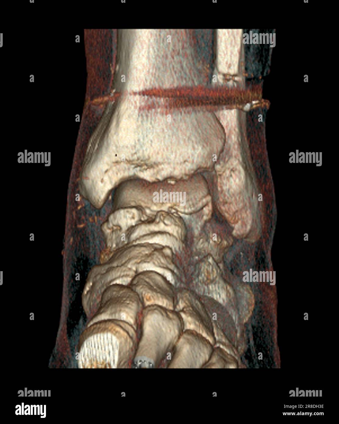 Coloured 3D computed tomography (CT) scan of the pinned ankle of a 32