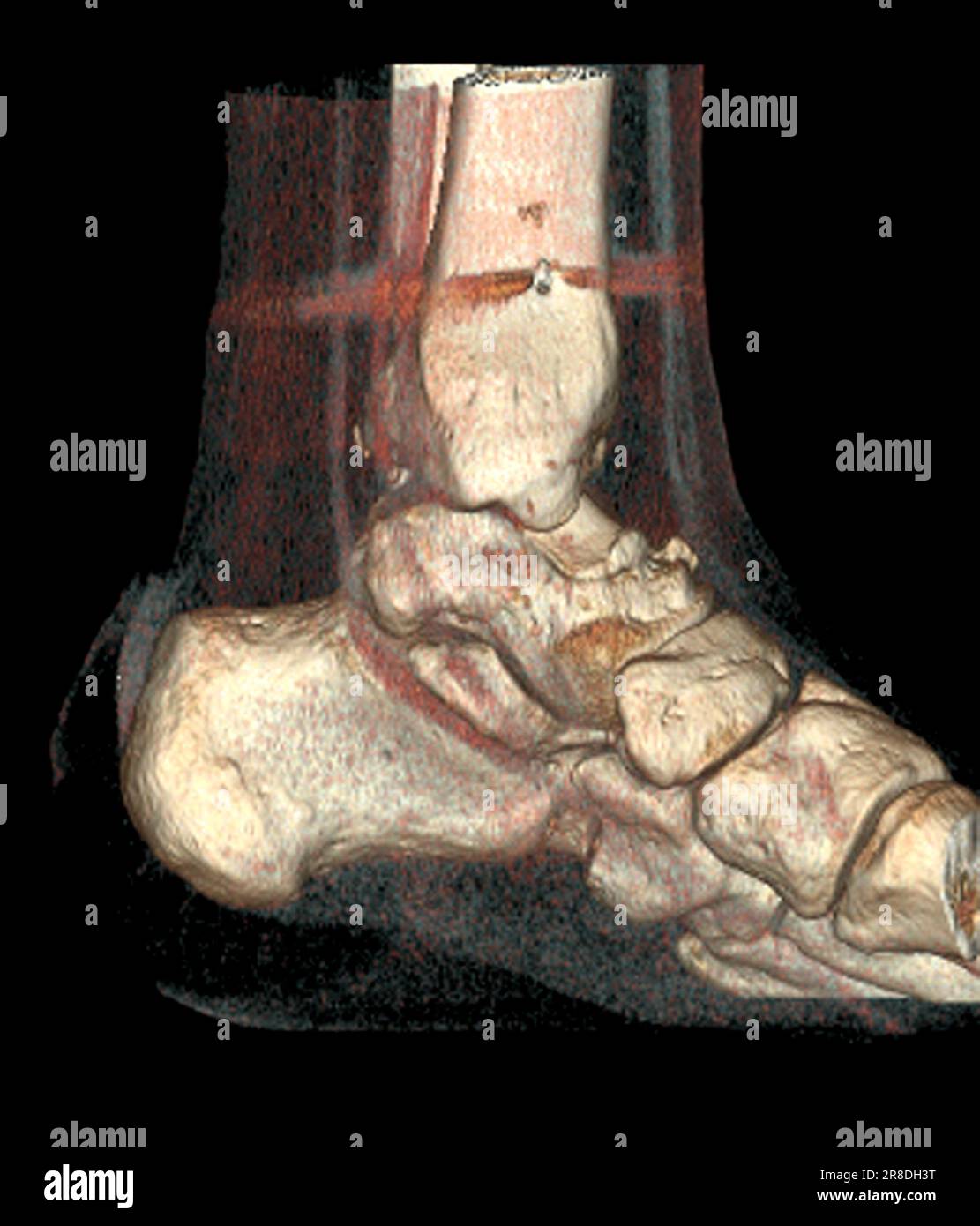 Coloured 3D computed tomography (CT) scan of the pinned ankle of a 32