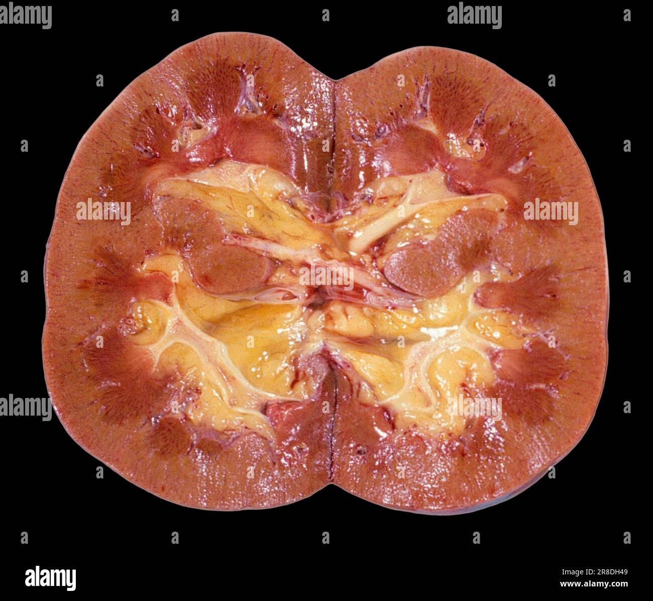Gross specimen of a crosssection through a healthy kidney. The kidneys