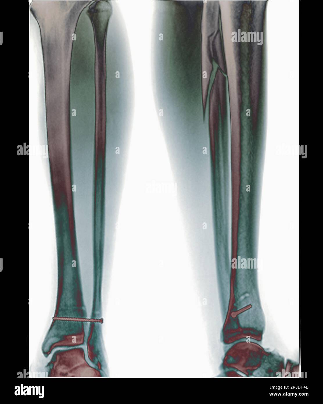 Coloured Xrays of the pinned ankle of a 32 year old male patient. A