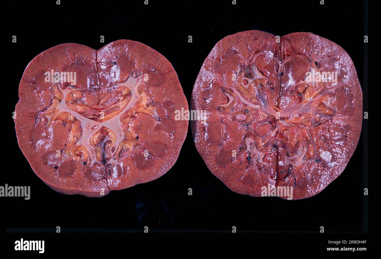 Gross specimen of crosssections through healthy kidneys. The kidneys filter waste from the