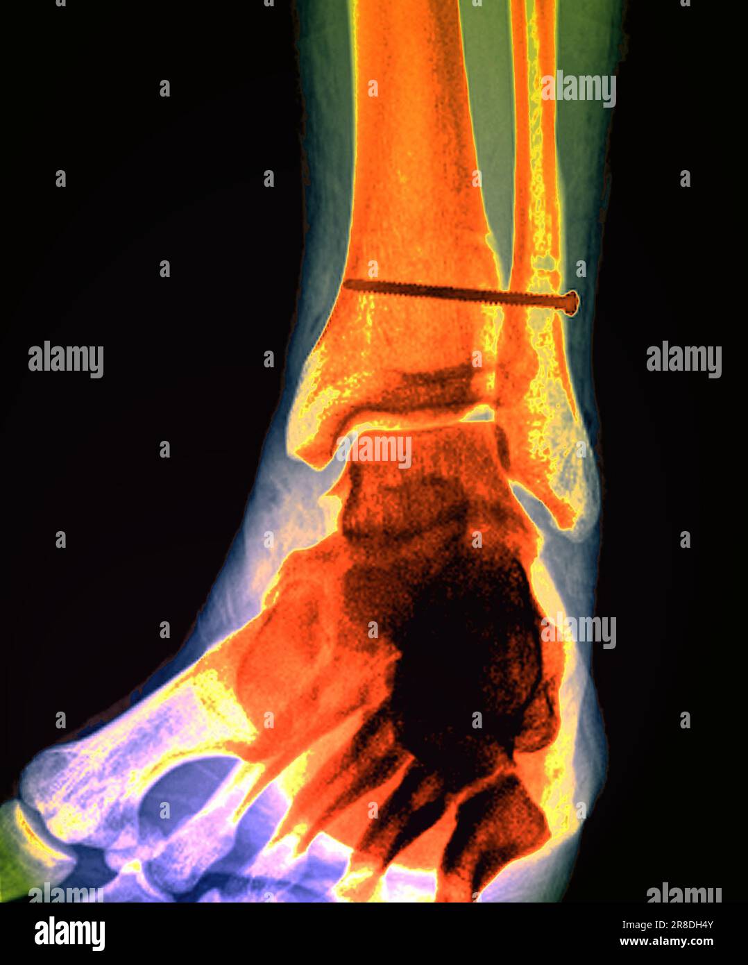 Coloured Xray of the pinned ankle of a 32 year old male patient. A