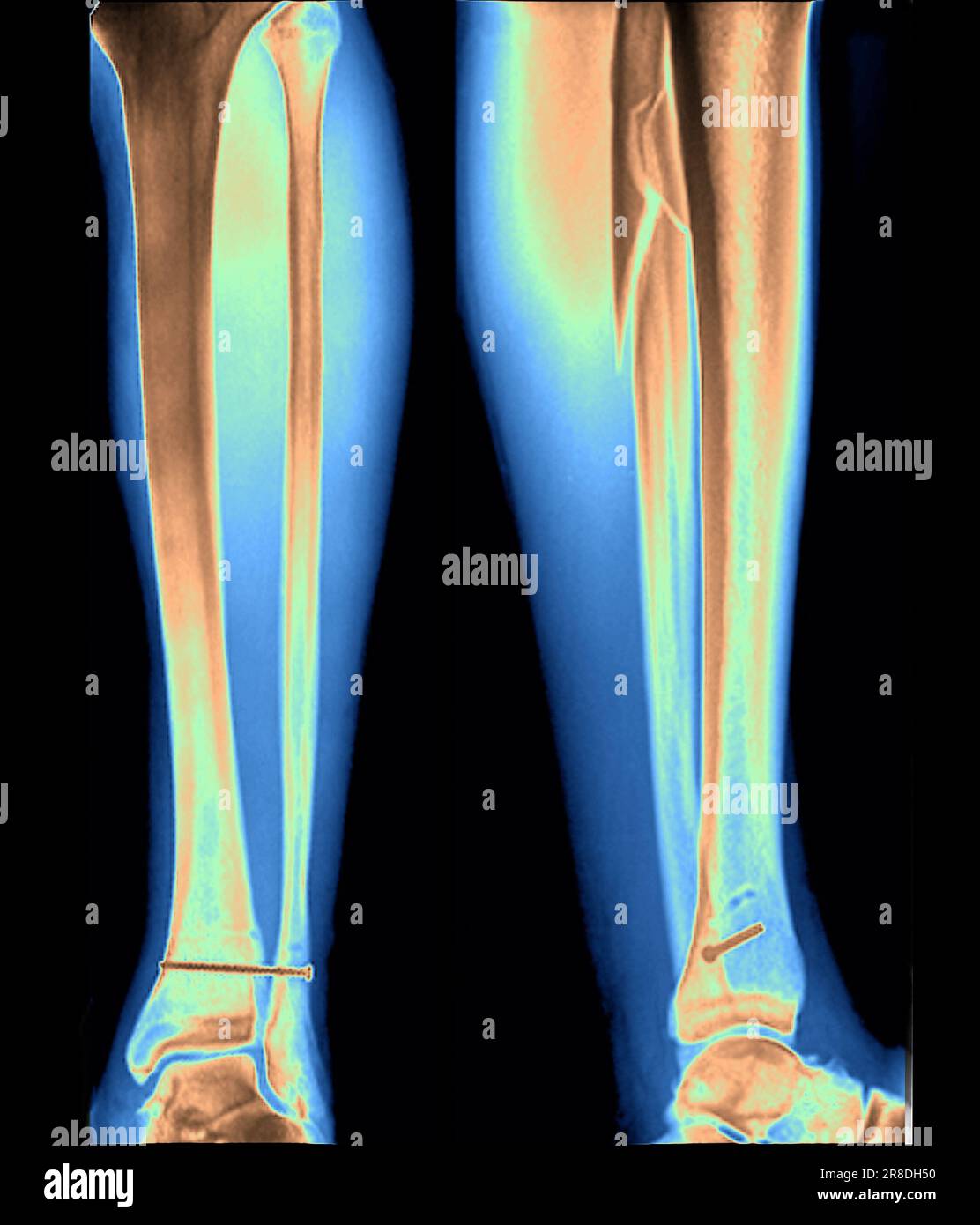 Coloured Xrays of the pinned ankle of a 32 year old male patient. A